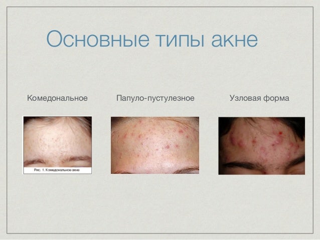 синтетическое, лечение угревой сыпи на современном этапе предмет